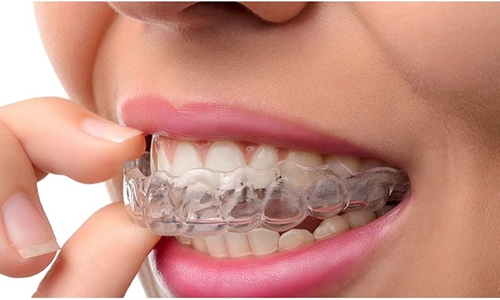 Aligners Treatment