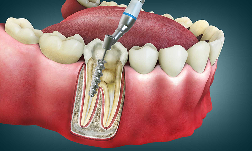Root Canal Treatment